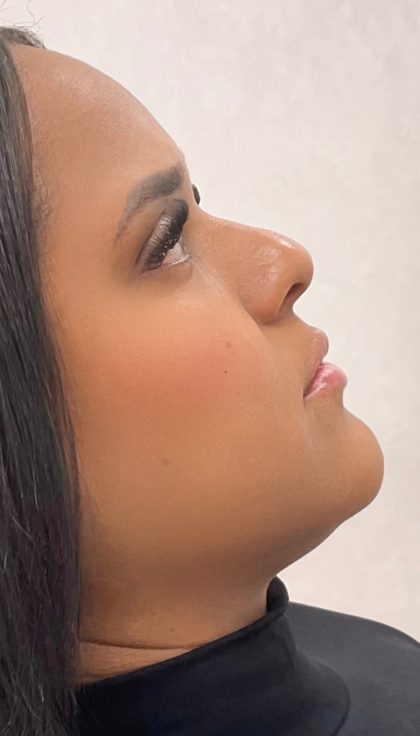 Facial Balancing With Fillers Before & After Patient #4283