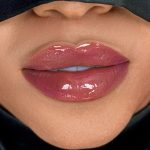 Russian Lips Before & After Patient #4397