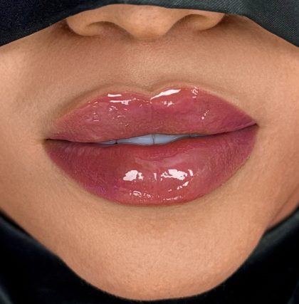 Russian Lips Before & After Patient #4397