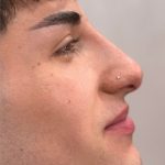 Liquid Rhinoplasty Before & After Patient #4322