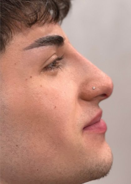 Liquid Rhinoplasty Before & After Patient #4322