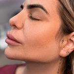 Chin Liposuction Before & After Patient #4246