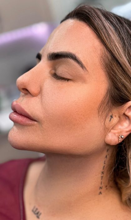 Chin Liposuction Before & After Patient #4246
