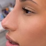 Liquid Rhinoplasty Before & After Patient #4325