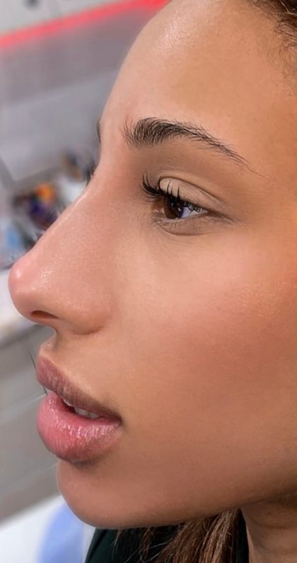 Liquid Rhinoplasty Before & After Patient #4325