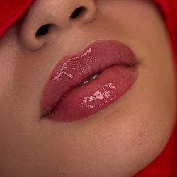 Russian Lips Before & After Patient #4337