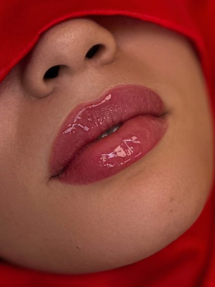 Russian Lips Before & After Patient #4337