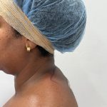 Buffalo Hump Liposuction Before & After Patient #4341