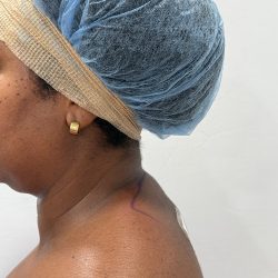 Buffalo Hump Liposuction Before & After Patient #4341