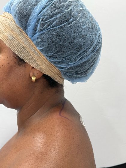 Buffalo Hump Liposuction Before & After Patient #4341