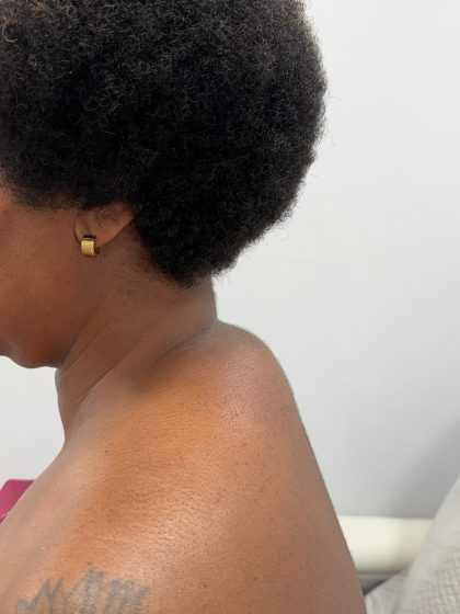 Buffalo Hump Liposuction Before & After Patient #4341