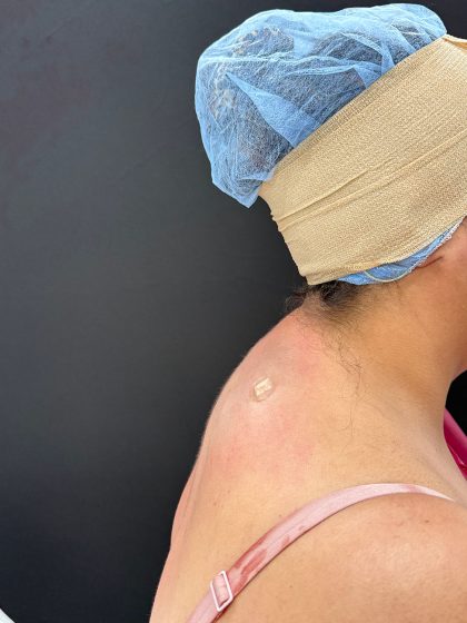 Buffalo Hump Liposuction Before & After Patient #4344