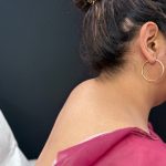 Buffalo Hump Liposuction Before & After Patient #4344
