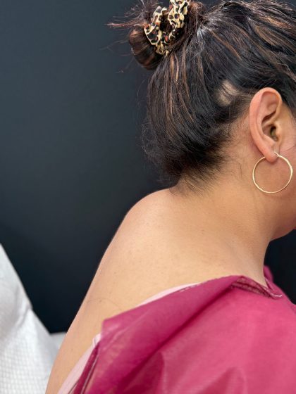 Buffalo Hump Liposuction Before & After Patient #4344