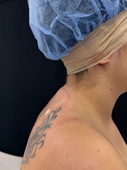 Buffalo Hump Liposuction Before & After Patient #4347