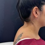 Buffalo Hump Liposuction Before & After Patient #4347
