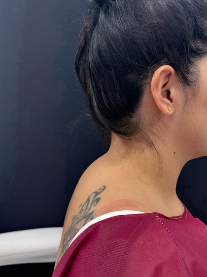 Buffalo Hump Liposuction Before & After Patient #4347